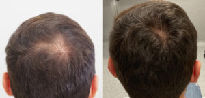 Typická androgénna alopecia u mužov - pred a po absolvovaní vlasovej mezoterapie