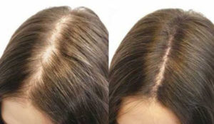 Typická androgénna alopecia u žien- pred a po absolvovaní vlasovej mezoterapie