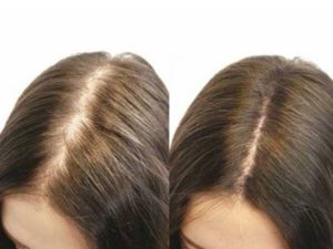 Typická androgénna alopecia u žien - pred a po absolvovaní vlasovej mezoterapie