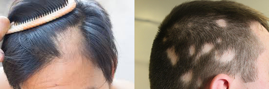Alopecia Areata – typické ohraničené vypadávanie na hlave