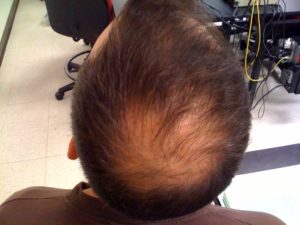 Androgénna alopecia na vrchole hlavy